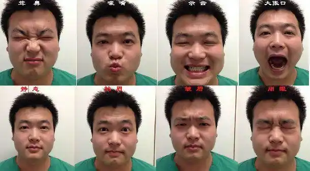 面瘫患者咨询前必读一照片准备