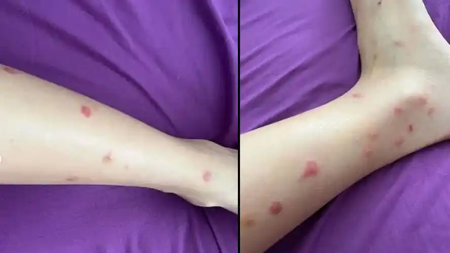 被床虱狂咬1个月朱智贤因创伤后遗症噩梦连连