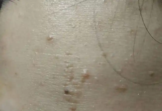 16岁女生手臂上长菜花被母亲痛骂医生为母亲检查发现真相