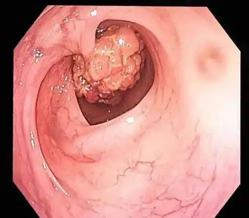 结肠巨大肿瘤,双镜联合根除