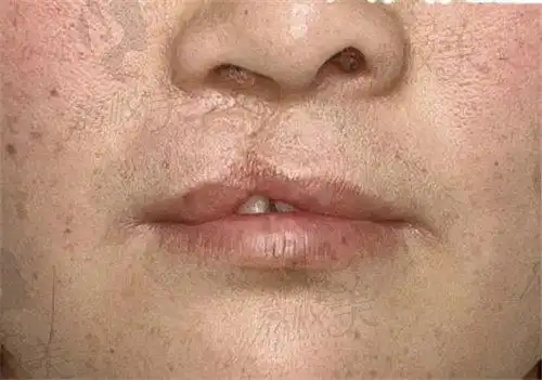 合肥韩美是唇裂修复好的医院之一刘冷二期修复即刻明显2w起