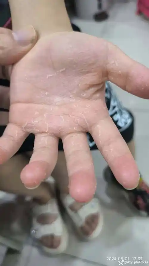 小儿双手起皮屑.略痛痒