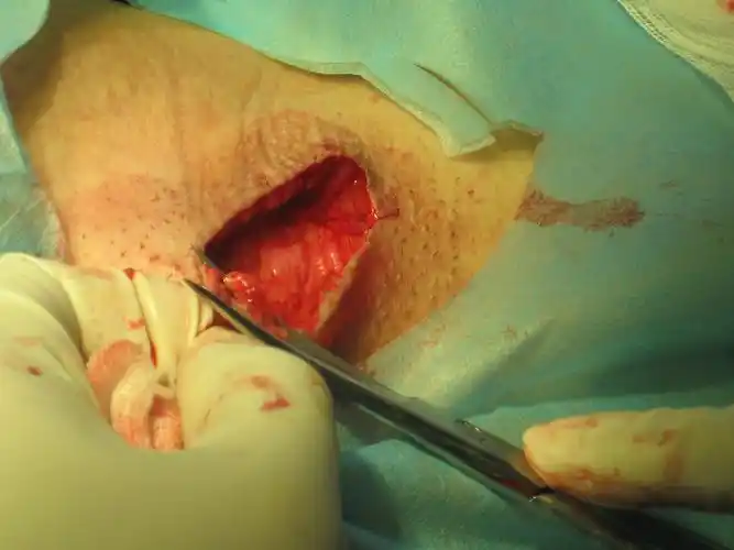 改良腋臭大汗腺切除术