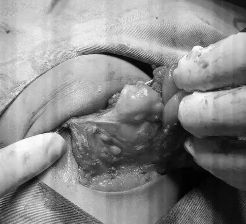 宝宝屁股上长了个"鸭蛋",到底是啥东东?