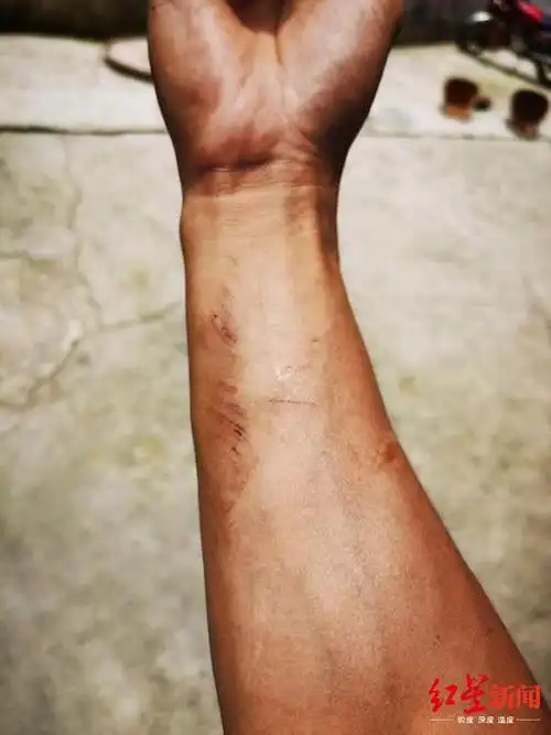 张洪波手臂至今伤痕累累