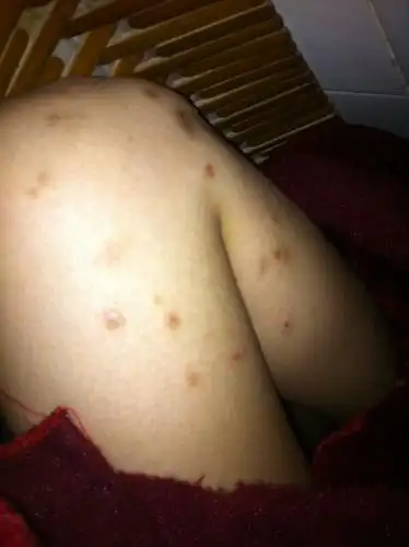 这样的疤痕如何去得掉.十多年了.求答案