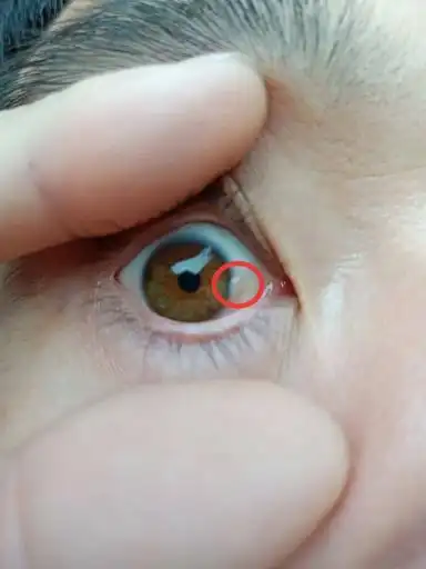 发痒,眼白发黄,经常揉眼,结果前天照镜子发现长个水泡一样的疙瘩,请问