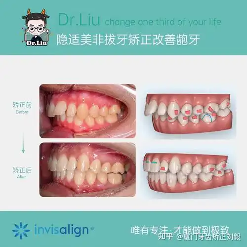 矫正前后口内牙齿对比图