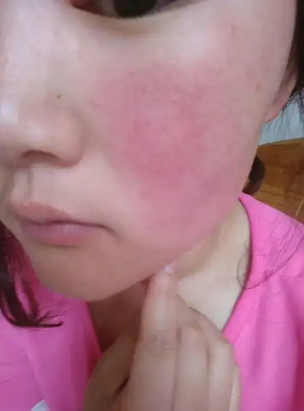 如果停用面膜后脸部有好多红血丝,脸部发红发烫.