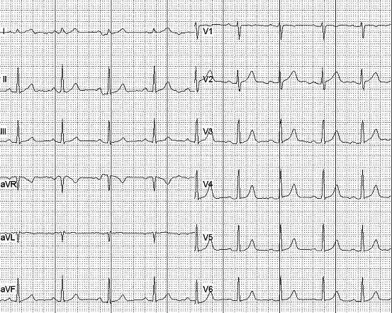你还在为看不懂心电图而烦恼吗?