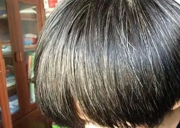 真的会有人"一夜白头"吗?白发掉发,健康警讯