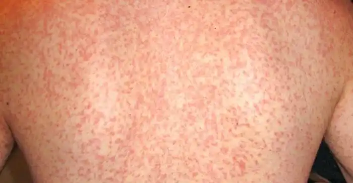 病毒疹和病毒性皮肤病