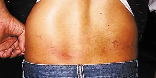 被打记者腰部受伤.