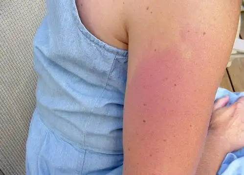 晒伤后的皮肤变红,该如何进行挽救呢?