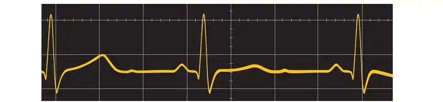 如何生成复杂的心电图(ecg)波形?