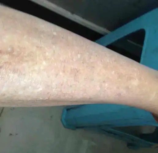 汗斑【多图】_39医疗图集-39健康网