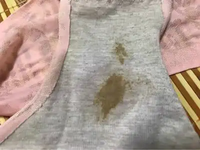 96,平时白带也有黄色,问医生说这个很正常,到今天看到内裤上看着像