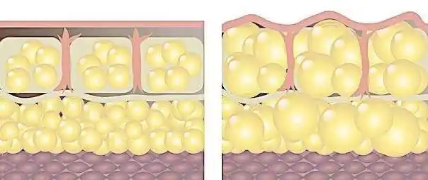 有一种脂肪能消耗脂肪