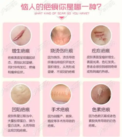 烫伤一年后的疤痕增生在成都医大疤痕研究院修复好了