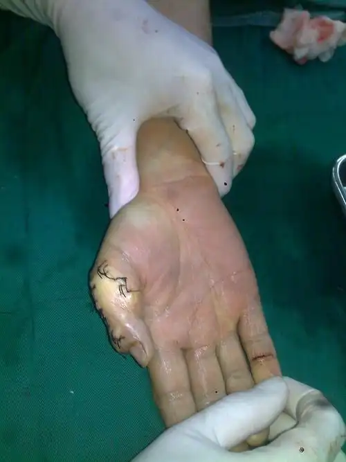 大拇指畸形手术 - 好大夫在线