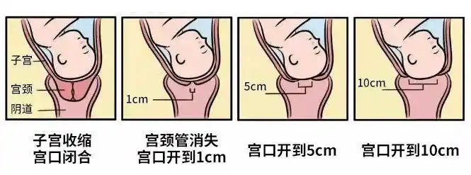"开十指"就是一个小西瓜大小▼一般来说,宫口开全至8-10cm才适合胎