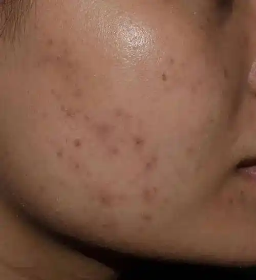 皮肤上突然冒出的小黑点,到底是啥啊?