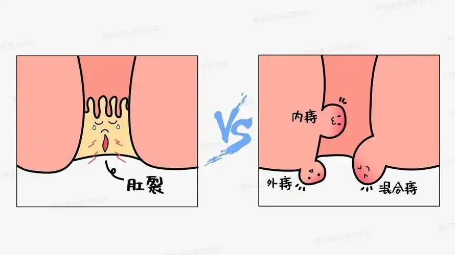 女人轻微痔疮图片(肛门疼痛) - 赤虎壹号