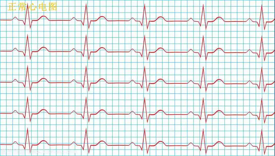 健康科普心电图报告上的小奥妙