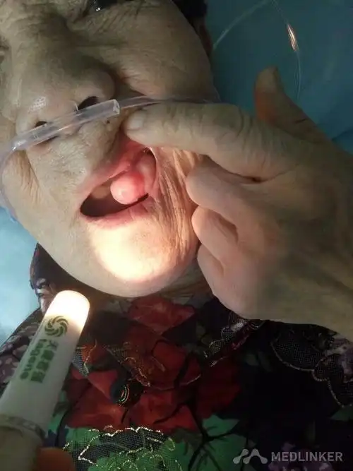 巨大牙龈瘤一例拟手术治疗