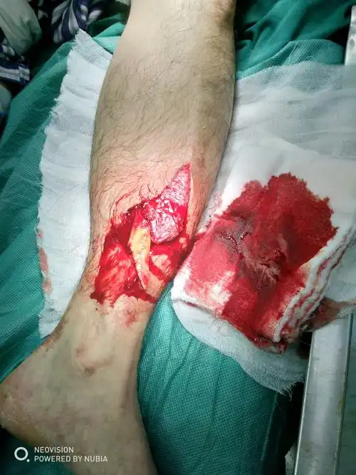 骨折好得偏方_哺乳期得乳腺炎的偏方_骨折夹板好还是石膏好