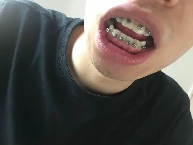 牙齿矫正日记(五)终于来了!牙套