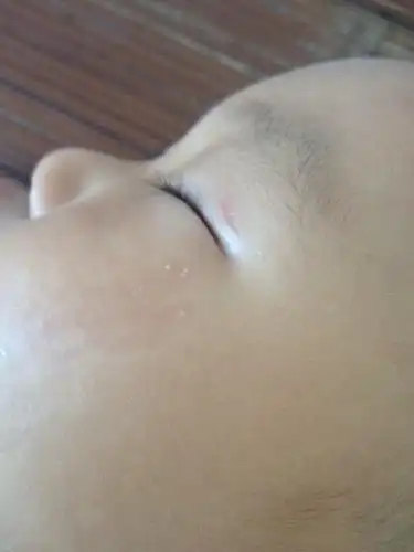 问:小孩脸上生了这个,不痛不痒,不知道是什么