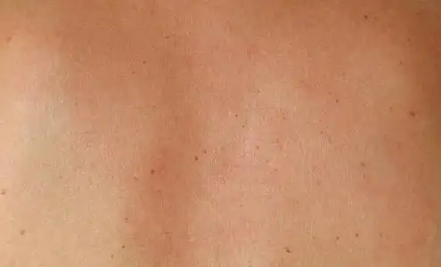 清迈发现人体皮肤纹理照片