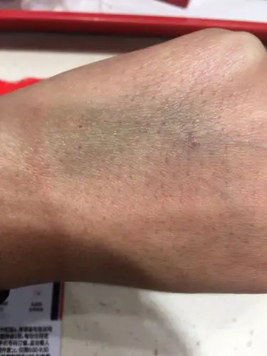 12.28针眼与输液