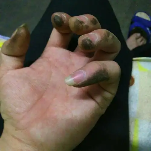 到晚上的时候手指头上突然出现黑色的东西,这是怎么回事.