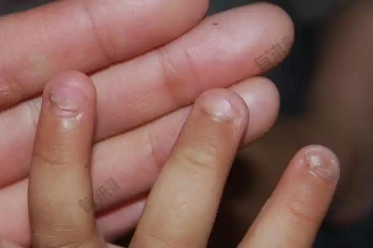 严重缺锌的手指甲图片_有来医生