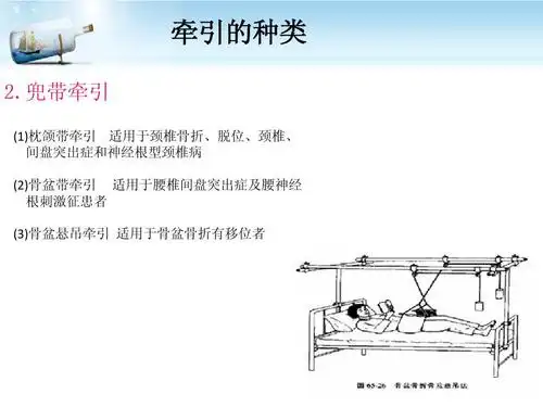 牵引的护理ppt