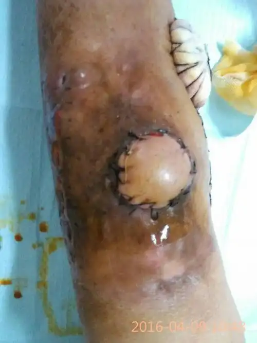 再做皮瓣外科手术! - 好大夫在线