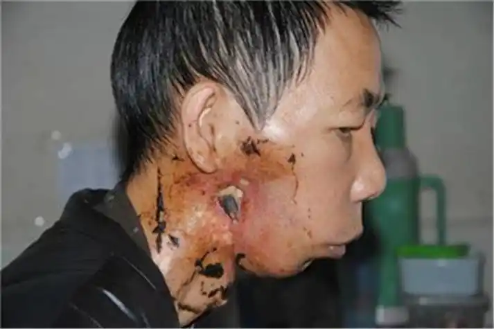 骨髓炎慢性症状图片骨髓炎脸部表现图片骨髓炎脸部严重症状图片骨髓炎