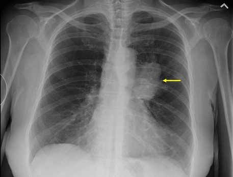 图2普通胸片中可见小细胞肺癌(黄色箭头).