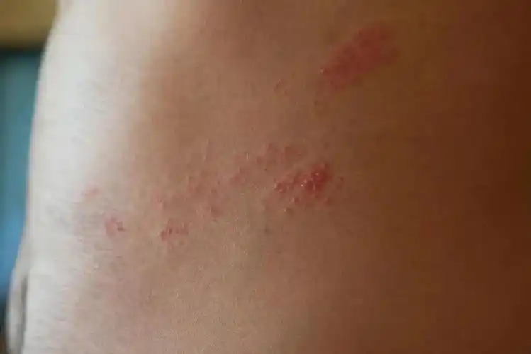 "蛇缠腰"比生孩子还痛!别让它盯上咱爸妈|新冠肺炎_新浪财经_新浪网