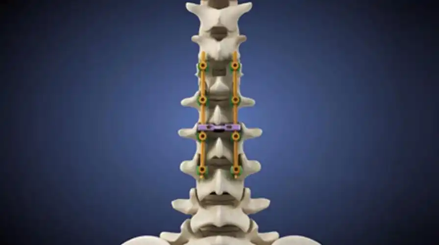 骨科产品--胸腰椎