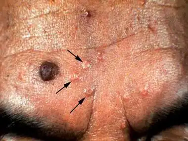 肿瘤疾病常用的疾病动物模型_尖锐湿疣疾病_阴道湿疣宫颈湿疣能人工