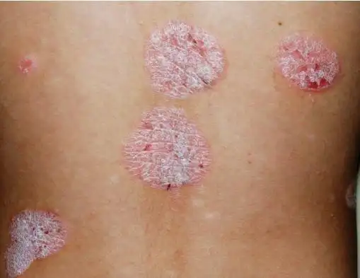 小孩牛皮癣图片