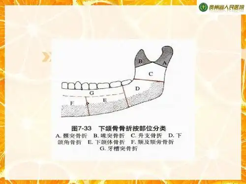 下颌骨骨折手术治疗ppt