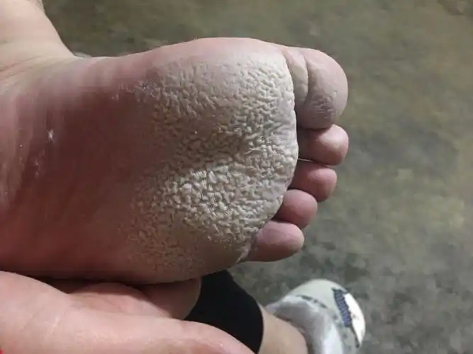 脚底起好多白色的东西,是怎么回事