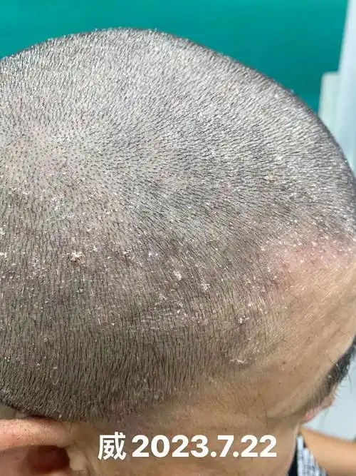 各种的激素类药膏,不管三七二十一,就是往头上摸,结果头皮屑没有消失