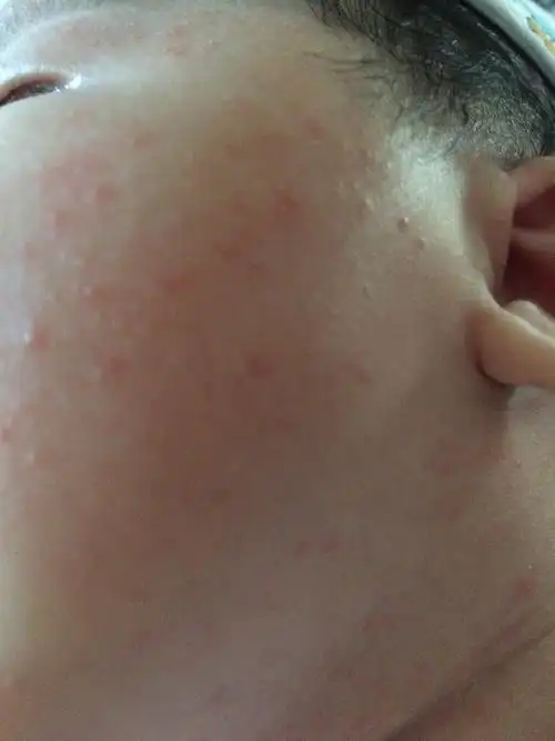 宝宝脸上长的这是痱子还是湿疹,宝妈帮忙看看