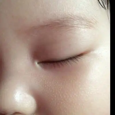 想知道宝宝鼻翼两侧两颊处的这些小白点点是什麼呀?好像从出生就有.