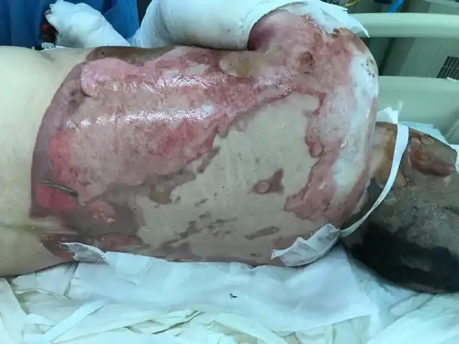 一例大面积烧伤病例汇报